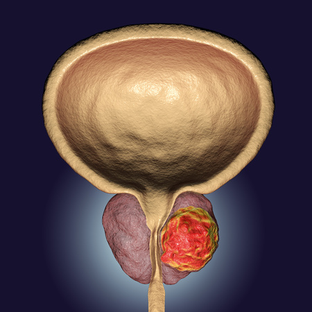 Prostate Cancer Symptoms 