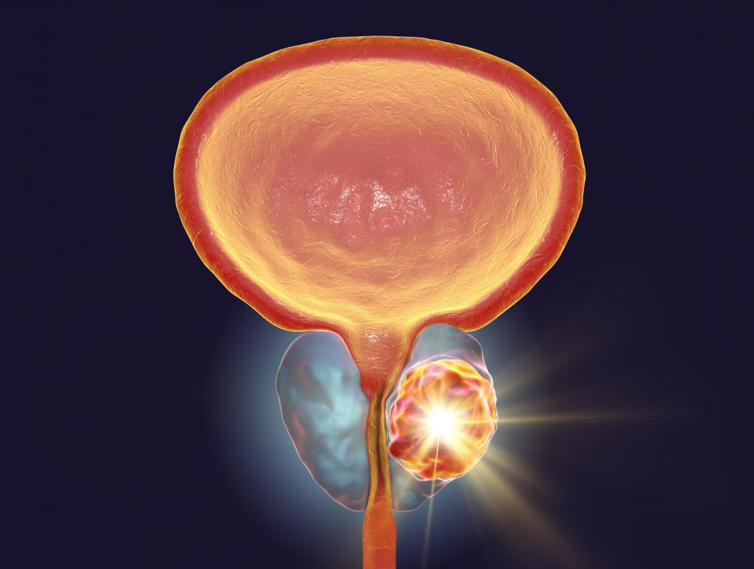 Prostate Cancer Symptoms