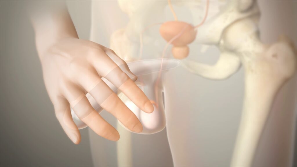 Penile Prosthesis Implantation
