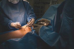 Varicocele surgery