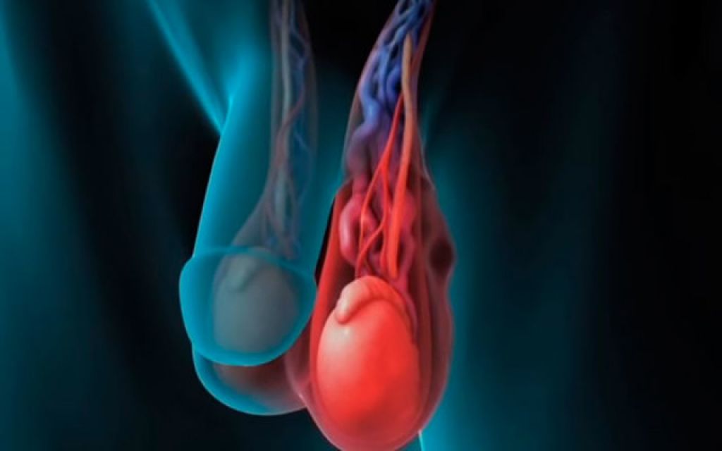 Varicocele Surgery