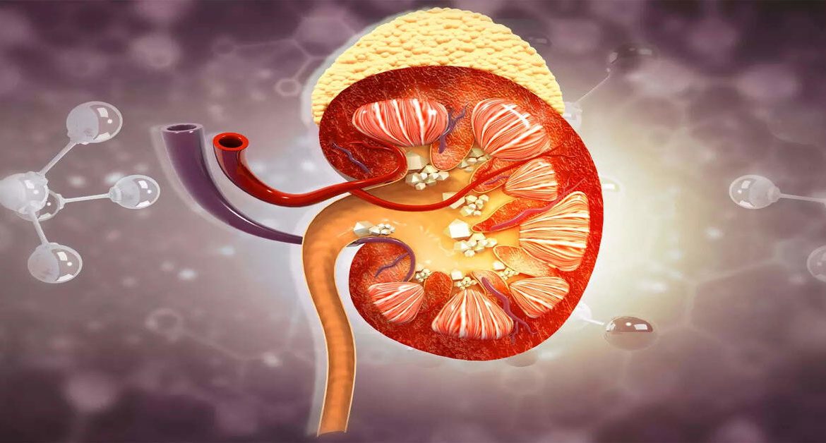 Kidney Stone Surgery 2 Kidney Stone Surgery
