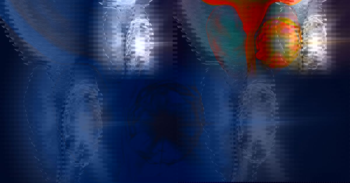 Prostat Kanseri Neden Olur? 4 Prostat Kanseri Neden Olur?