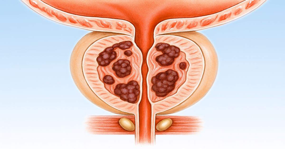 Prostat Kanseri Neden Olur?