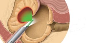 What is Laser Prostate Surgery?