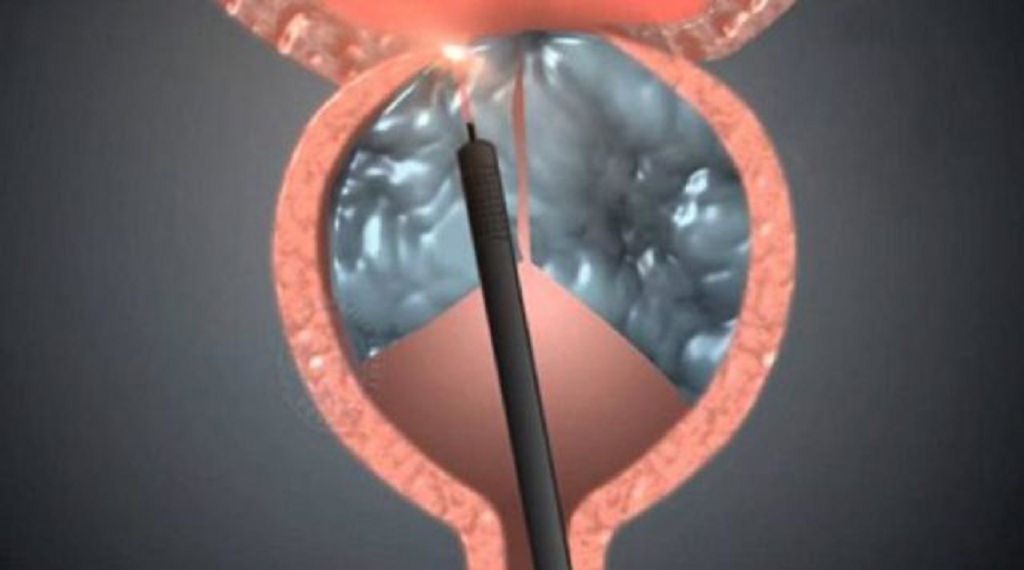 What is Laser Prostate Surgery?