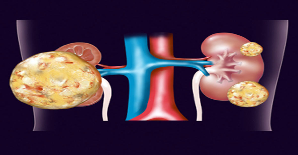 Kidney Cancer in the Elderly 3 Kidney Cancer in the Elderly