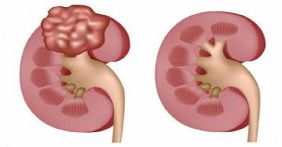 Kidney Cyst 3 Kidney Cyst