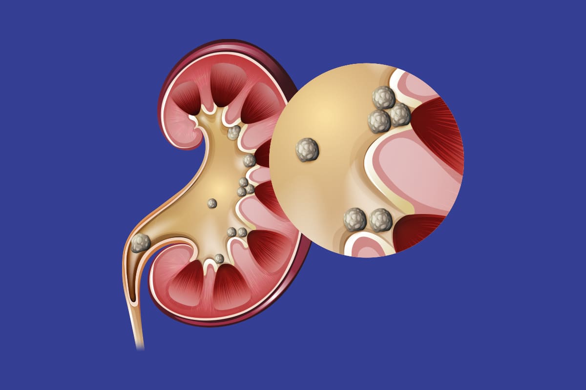 Kidney Stone Disease