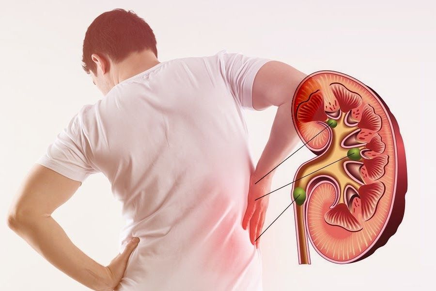 Kidney Stone Disease