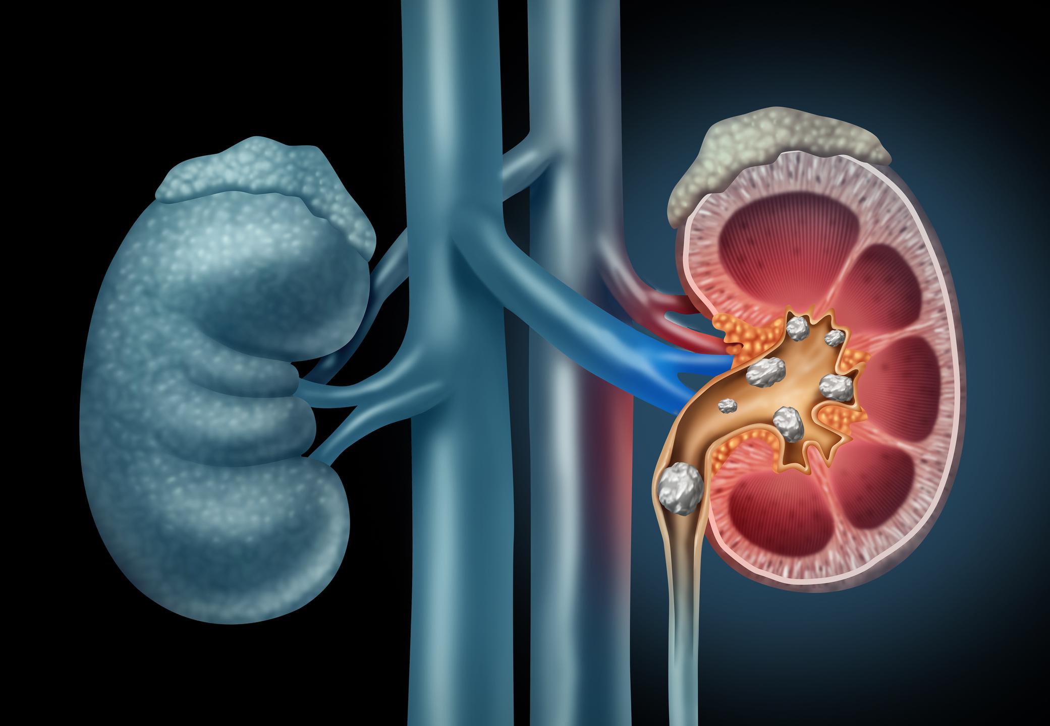 Kidney Stone Disease