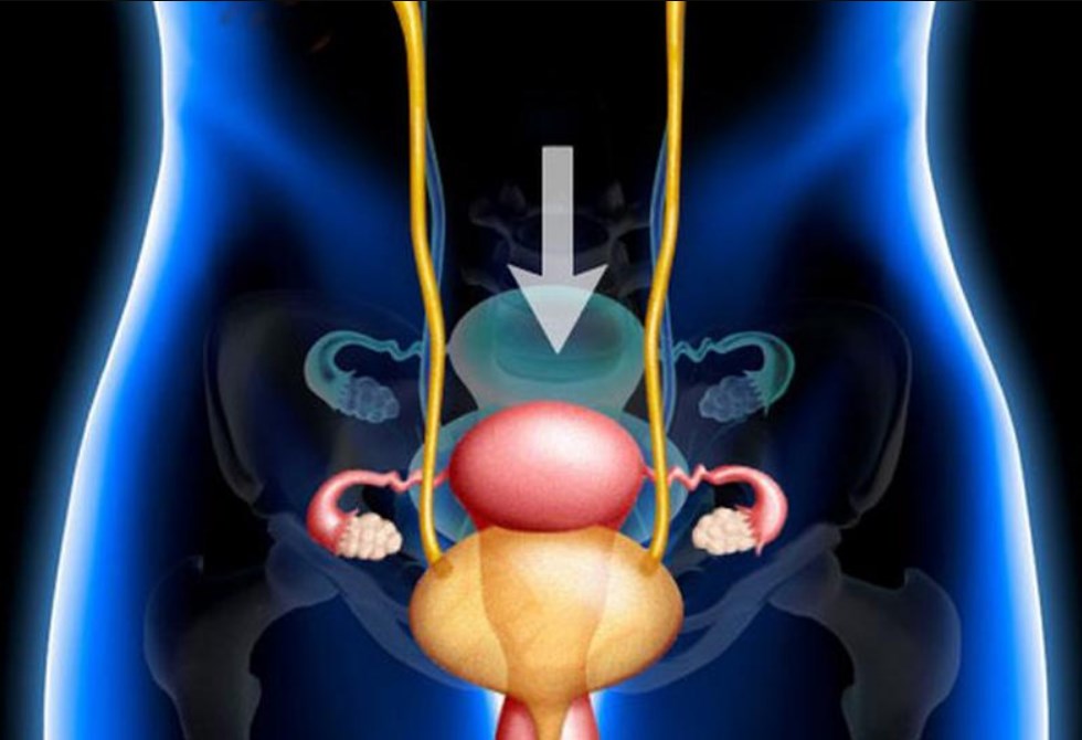 Bladder Prolapse