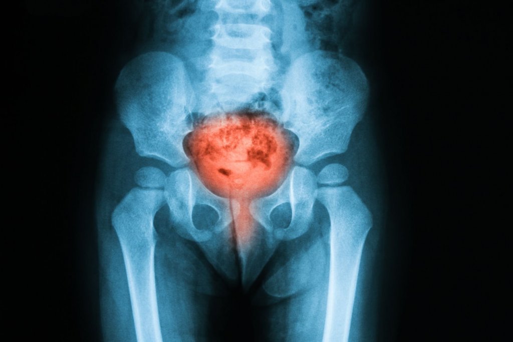 Bladder Inflammation