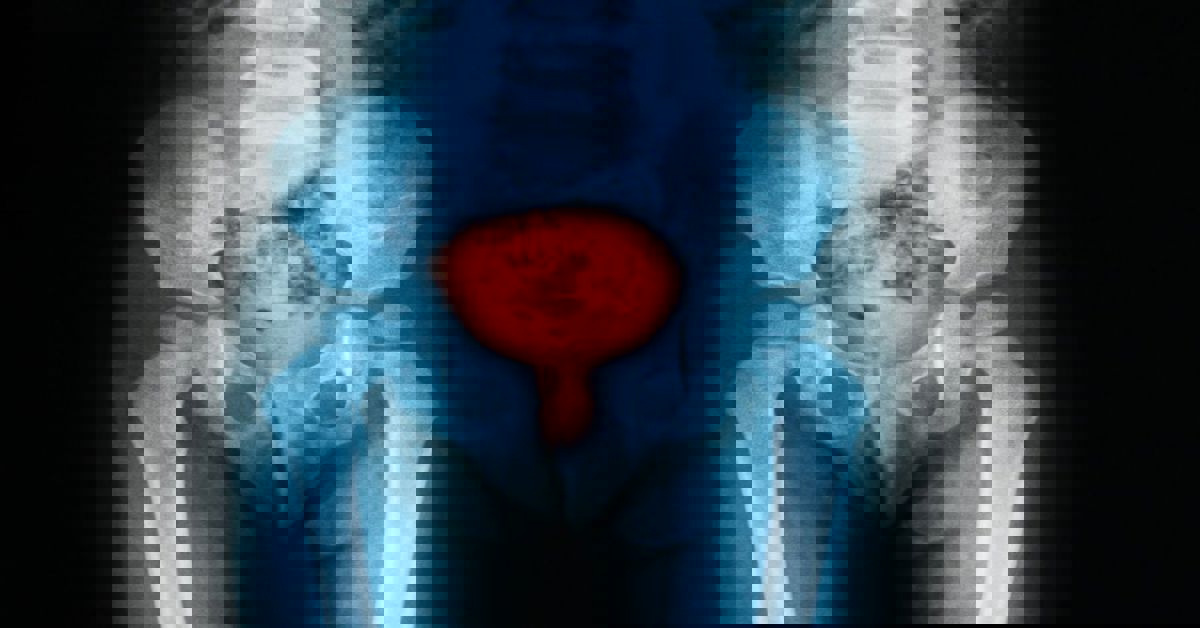 Воспаление мочевого пузыря 4 Воспаление мочевого пузыря