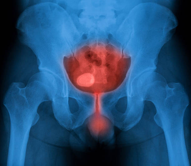 Bladder Inflammation