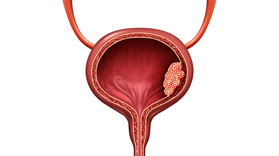 Bladder Inflammation