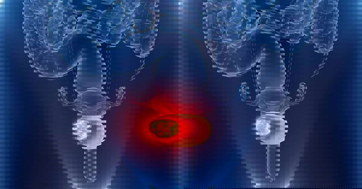 عدوى البروستاتا 3 عدوى البروستاتا