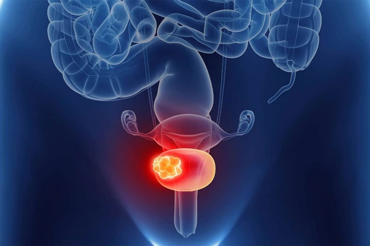 Prostate Infection