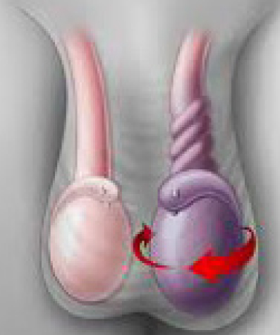 Testis İltihaplanması