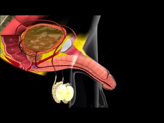 Testis İltihaplanması