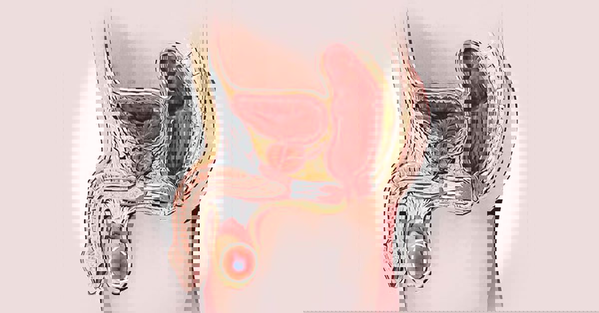 Testis Torsiyonu 3 Testis Torsiyonu