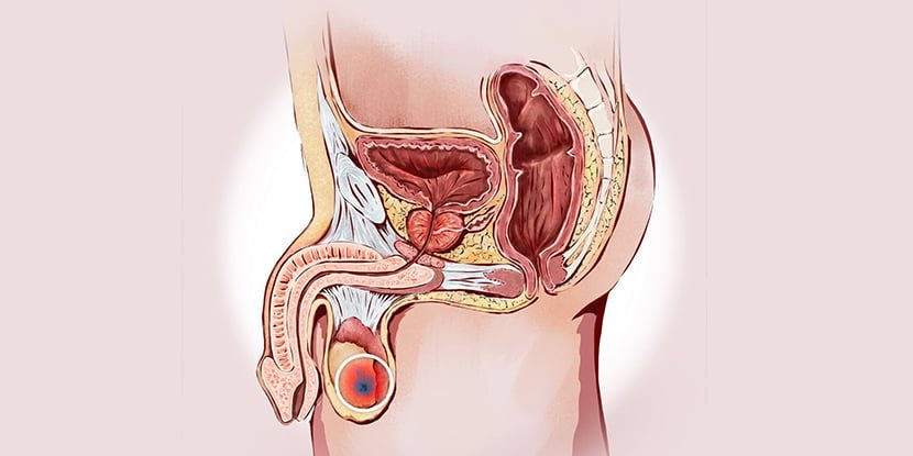 Testis Torsiyonu