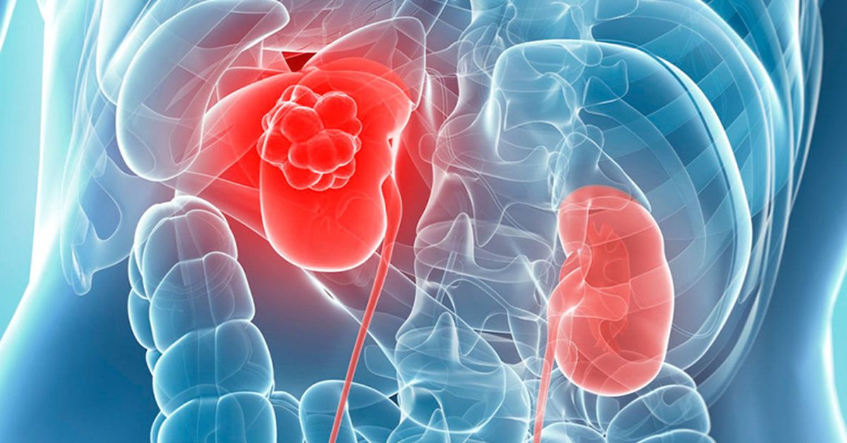 Kidney Cancer Treatment 1 Kidney Cancer Treatment