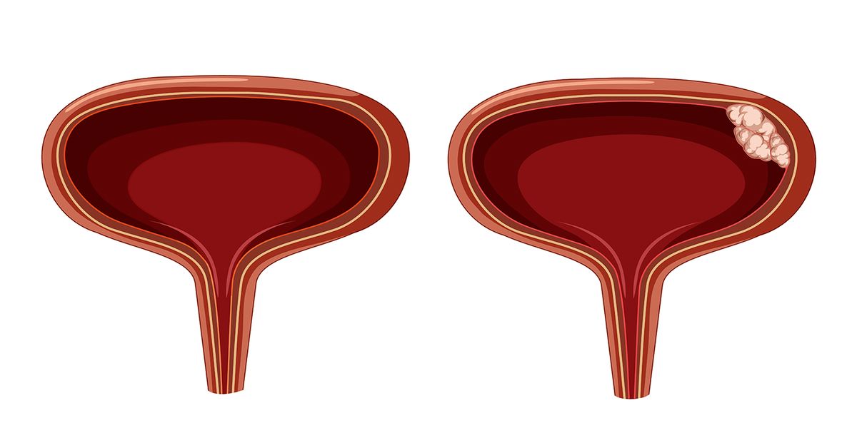 Mesane Kanseri Ameliyatı 4 جراحة سرطان المثانة