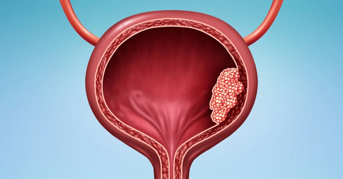 Mesane Kanseri Ameliyatı 7 جراحة سرطان المثانة