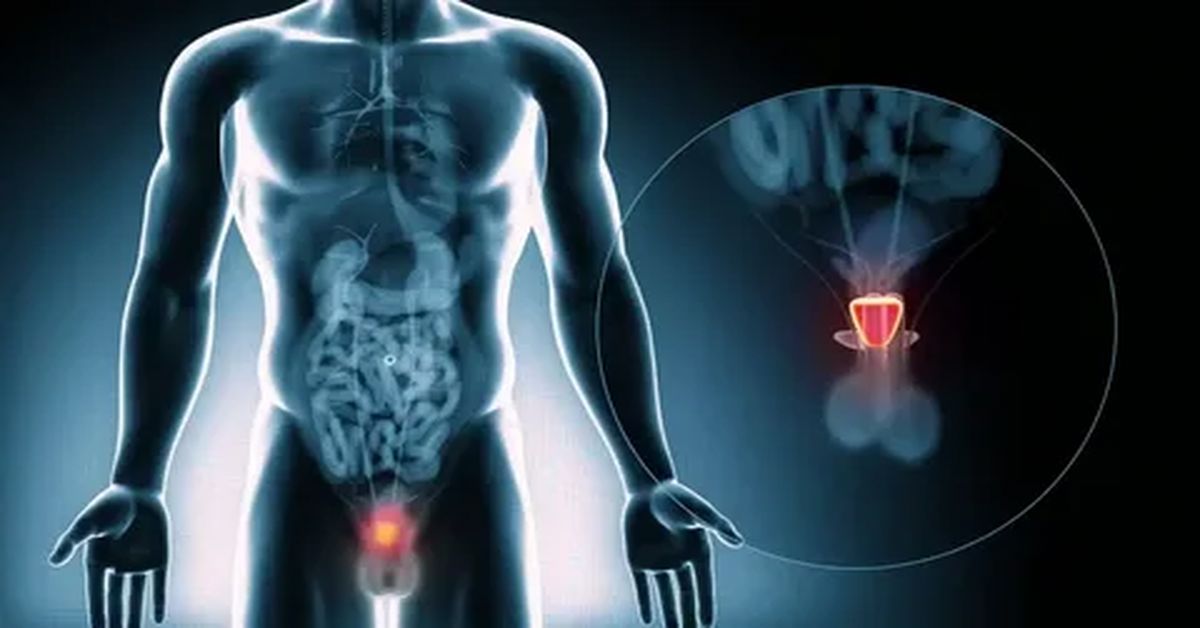 Prostat Kanseri Ameliyatı 3 Prostat Kanseri Ameliyatı