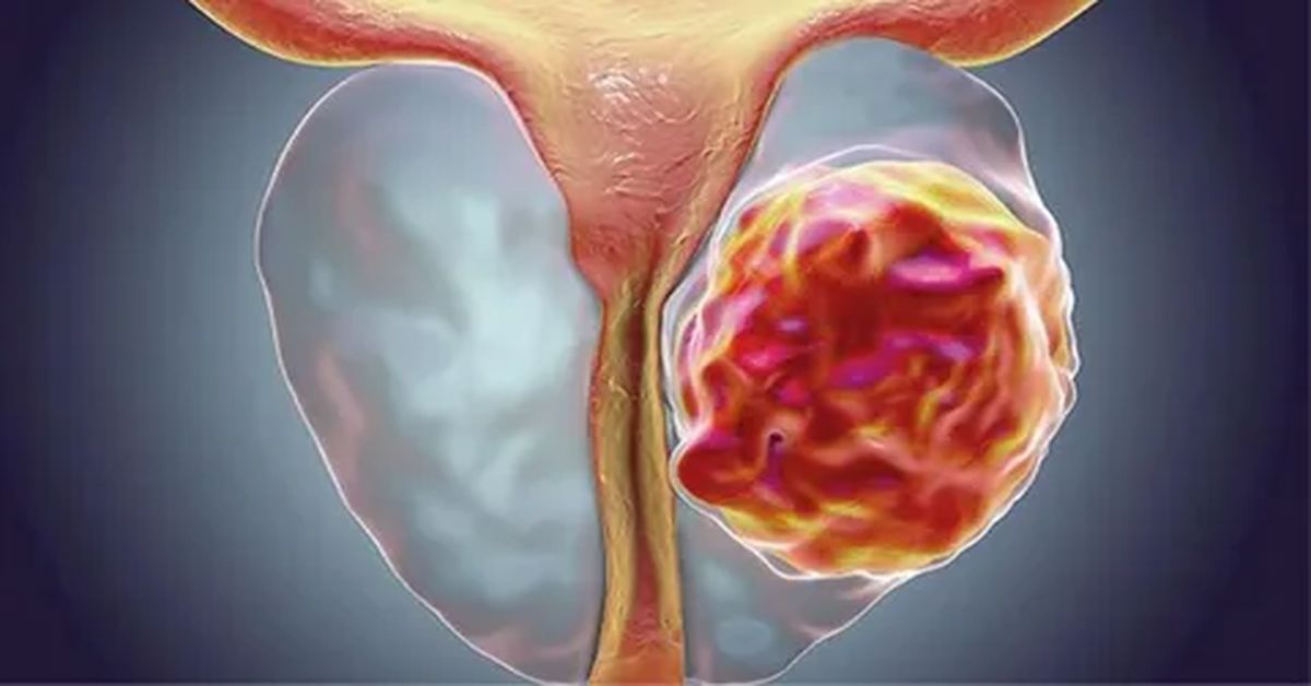 Prostat Kanseri Ameliyatı