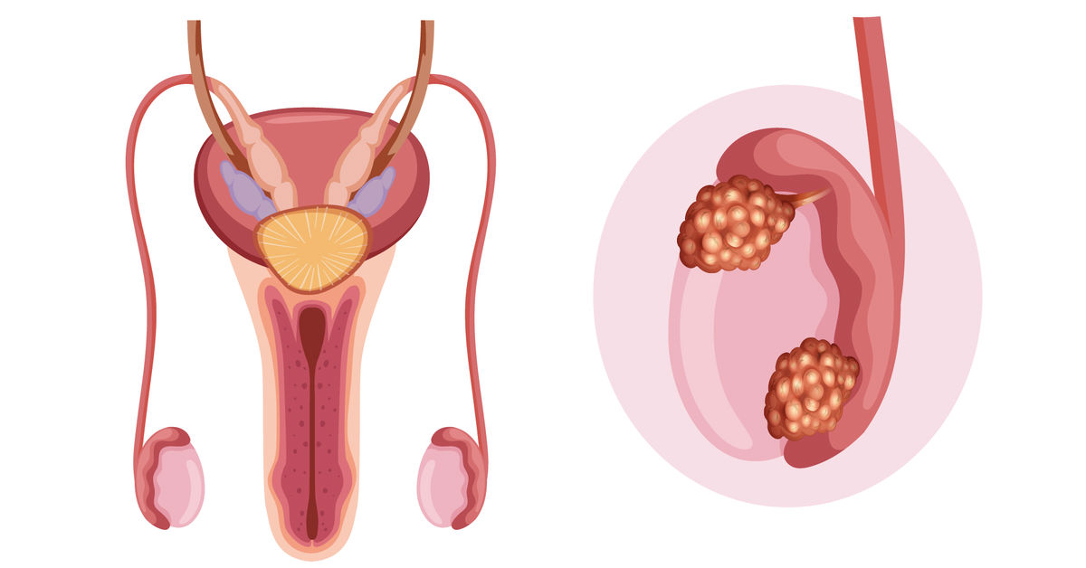 Testis Kanseri Nedir? 4 What is Testicular Cancer?